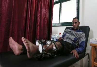 Kurang Dana, 1.700 Warga Palestina yang Tertembak Militer Israel Harus Diamputasi