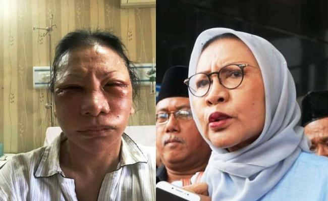 Fakta Kasus Ratna Sarumpaet bukan Korban Penganiayaan