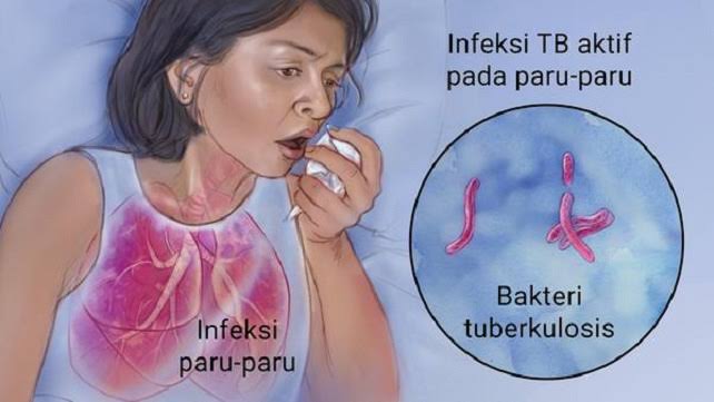 Diskes Pekanbaru Temukan 3.713 Kasus TBC, Warga Diminta Waspada