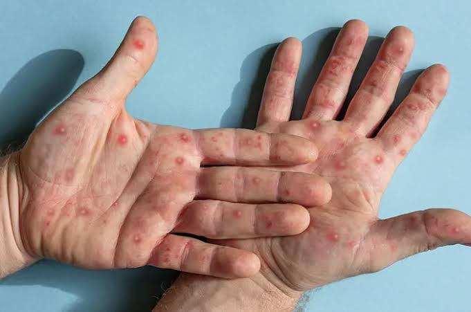Fakta Pasien Cacar Monyet Pertama yang Meninggal di Indonesia