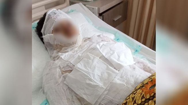 Sempat Dirawat setelah Dibakar Istri, Driver Ojol Meninggal Dunia  