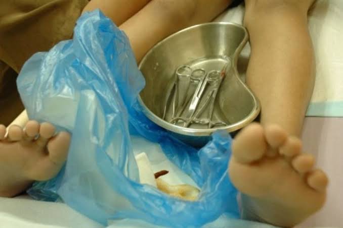 Kemaluan Anak Putus saat Disunat, Bidan di Pulau Muda Pelalawan Jadi Tersangka