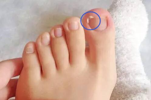 5 Cara Mencegah Kuku Kaki yang Cantengan