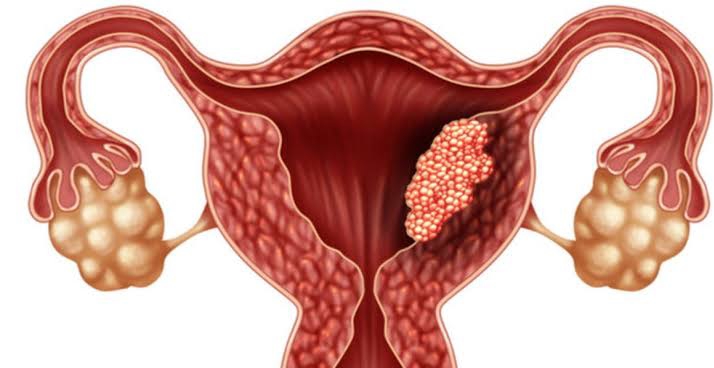 Ini Gejala dan Tanda Kanker Serviks yang Harus Diwaspadai Wanita