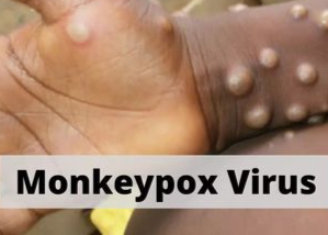 Waspada! Cacar Monyet Mulai Masuk Indonesia 
