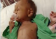 Derita Aidil Fitrah, Penderita Kanker Usus Butuh Uluran Tangan Dermawan