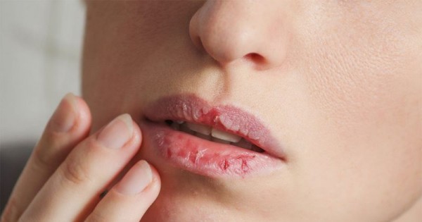 Kekurangan Vitamin B12 Mengakibatkan Bibir Pecah-pecah