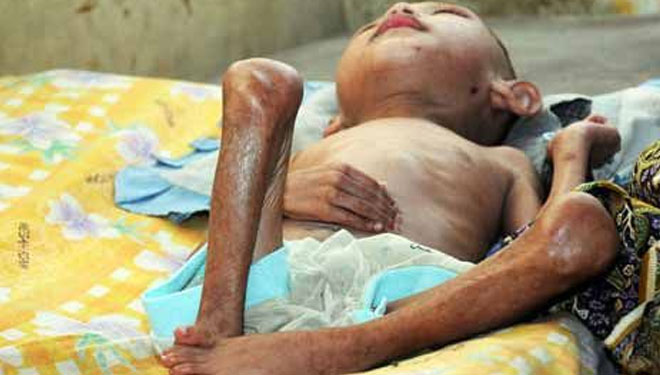 PBB: Pandemi Covid-19 akan Dongkrak Jumlah Anak Kurang Gizi