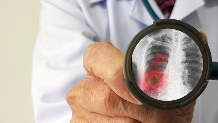 Kazakhstan Bantah China Soal Pneumonia yang Lebih Mematikan dari Corona