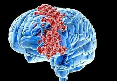 Dikira Flu, Anak Marcella Zalianty Idap Tumor Otak, 5 Jajanan Ini Jadi  Pemicunya 