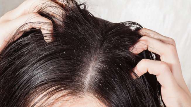 Bebaskan Rambut dari Ketombe dengan Cara Ini